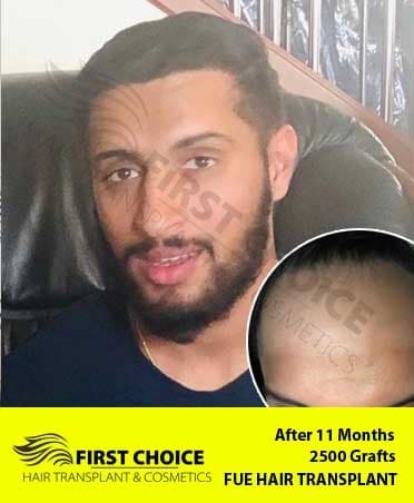 Hair Transplant Result of 2500 Grafts