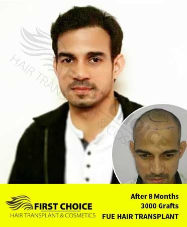 Hair Transplant Result of 3000 Grafts