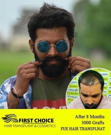 Hair Transplant Result of 3000 Grafts