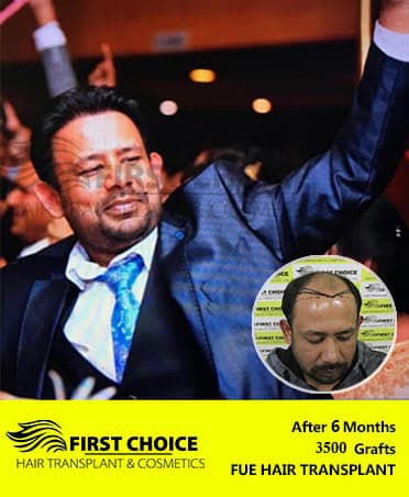 Hair Transplant Result of 3500 Grafts