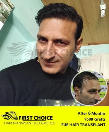 Hair Transplant Result of 2500 Grafts