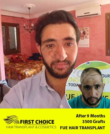 Hair Transplant Result of 3500 Grafts