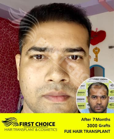 Hair Transplant Result of 3000 Grafts