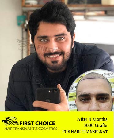 Hair Transplant Result of 3000 Grafts