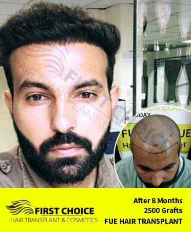 Hair Transplant Result of 2500 Grafts