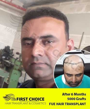 Hair Transplant Result of 5000 Grafts