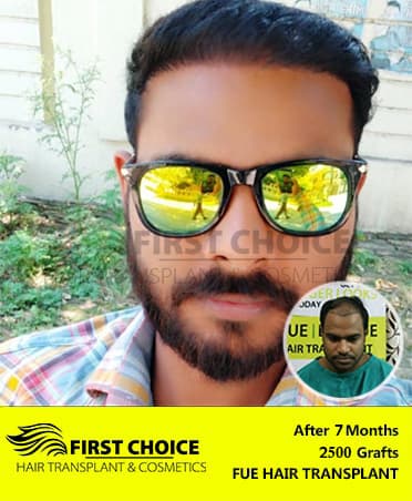 Hair Transplant Result of 2500 Grafts