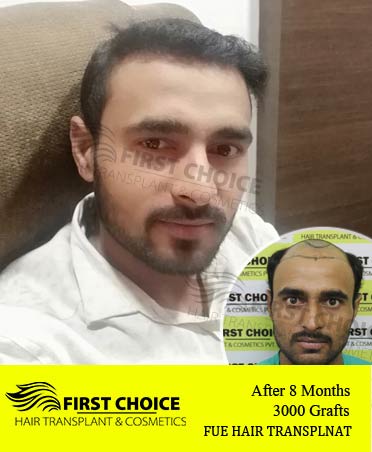 Hair Transplant Result of 3000 Grafts