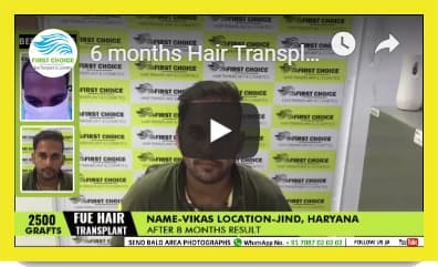 Hair Transplant results in Amritsar