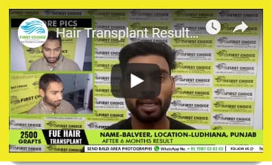 Hair Transplant results in Amritsar